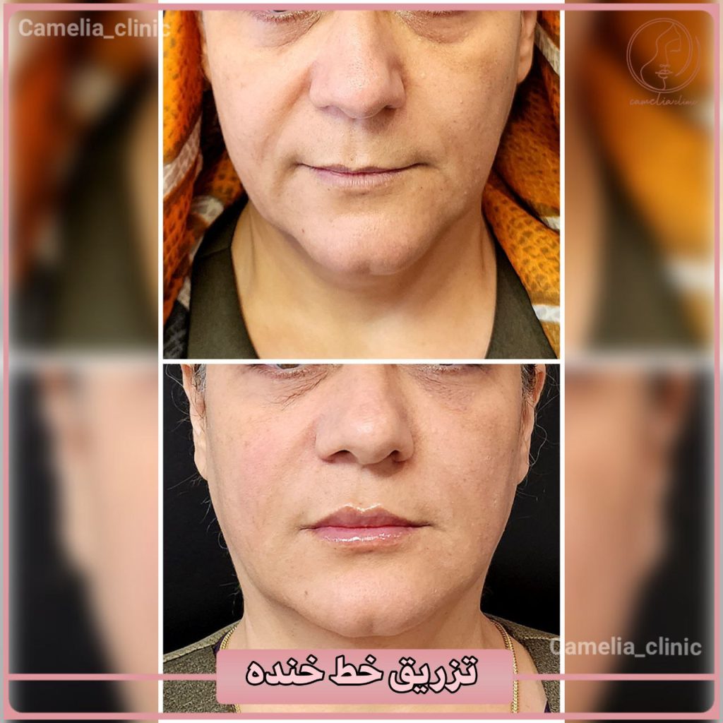 مرکز زیبایی کاملیا بهترین کلینیک پیلینگ در کرج |بهترین کلینیک پیلینگ در کرج