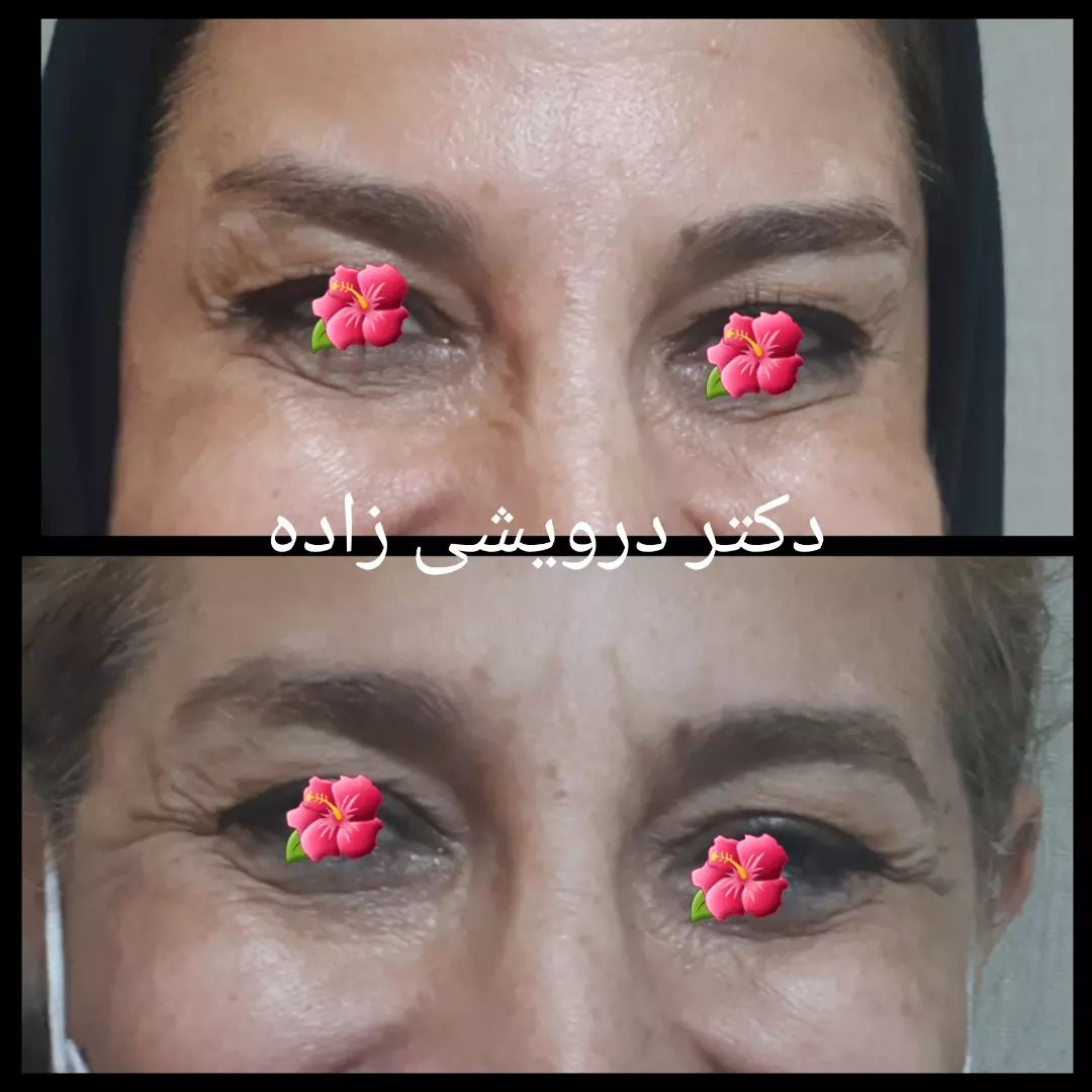 دکتر نادیا درویشی زاده دکتر میکرودرم| بهترین متخصص میکرودرم در تهران