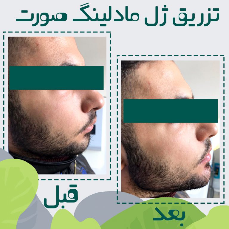 کلینیک سیب سبز کربوکسی تراپی| بهترین مرکز کربوکسی تراپی در تهران