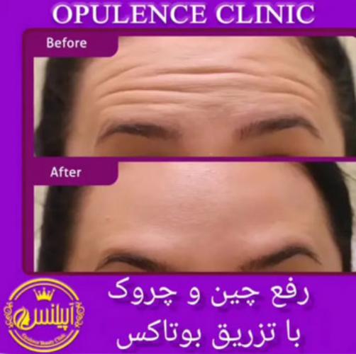 نمونه قبل و بعد رفع چین و چروک بوتاکس توسط کلینیک آپیلنس در کرج