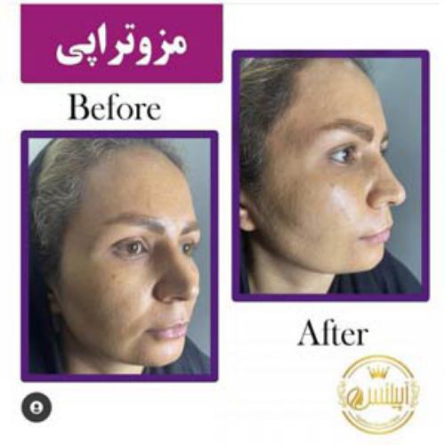 نمونه قبل وبعد مزوتراپی توسط کلینیک آپیلنس در کرج