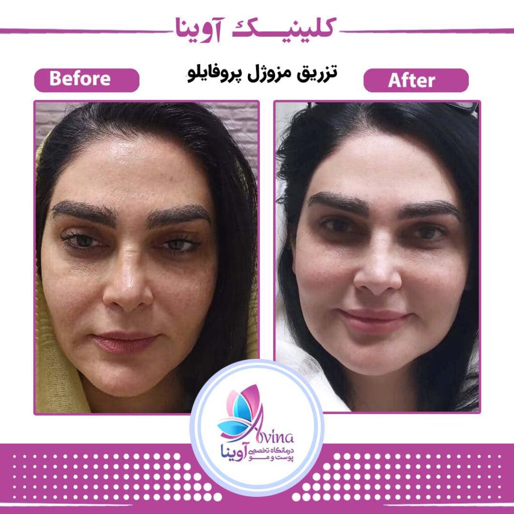 کلینیک تخصصی آوینا بهترین کلینیک کربوکسی تراپی| بهترین مرکز کربوکسی تراپی در تهران