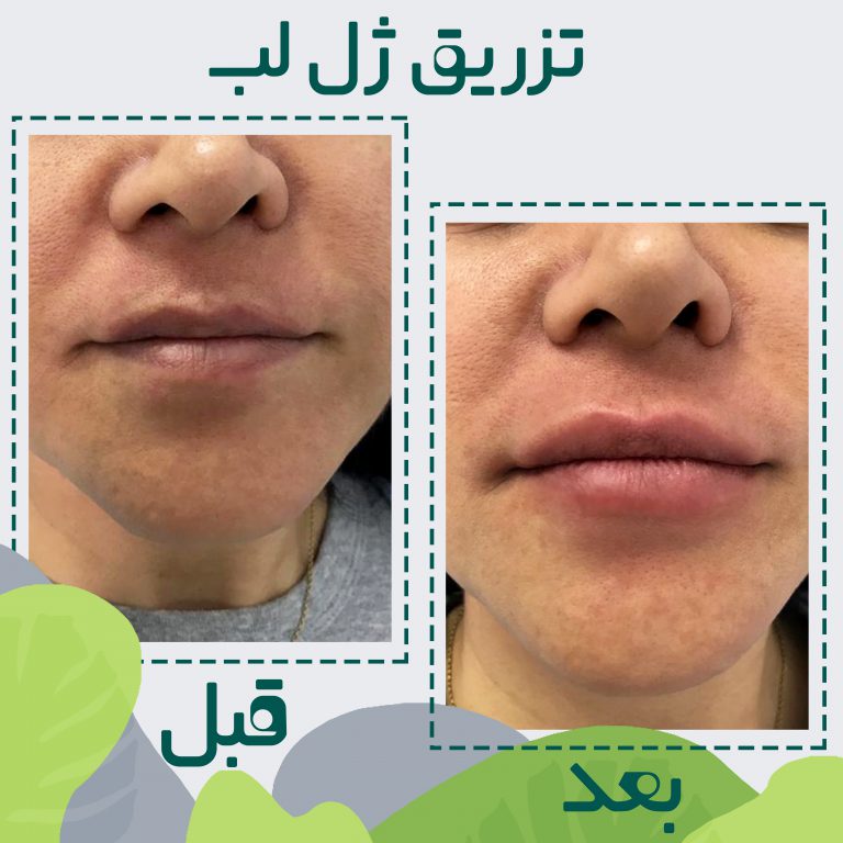کلینیک سیب سبز بهترین کلینیک کربوکسی تراپی| بهترین مرکز کربوکسی تراپی در تهران