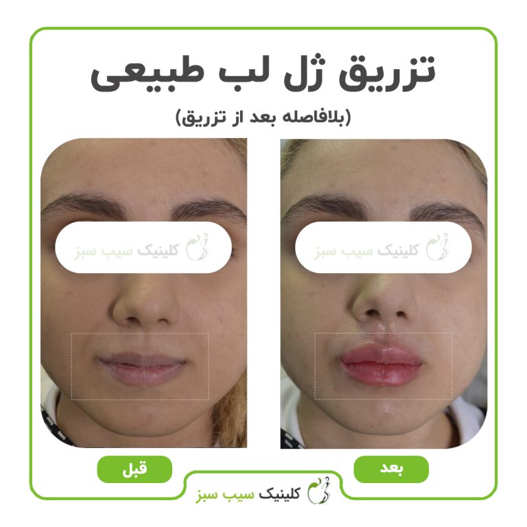 کلینیک سیب سبز بهترین کلینیک کربوکسی تراپی| بهترین مرکز کربوکسی تراپی در تهران