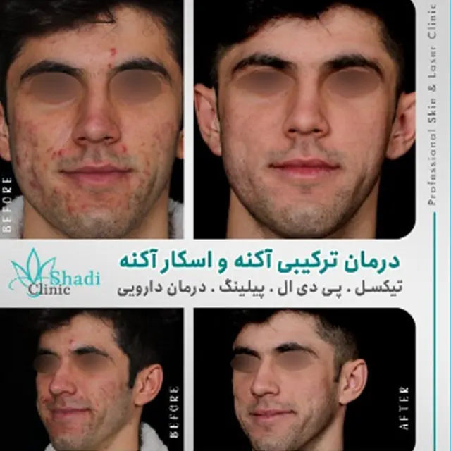 مطب دکتر شادی مظلومی بهترین مرکز پیلینگ در کرج |بهترین مطب پیلینگ در کرج
