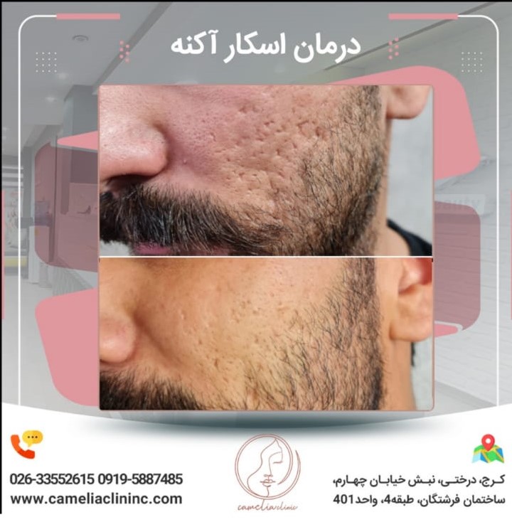 مرکز تخصصی کاملیا بهترین مطب پیلینگ در کرج |بهترین کلینیک پیلینگ در کرج