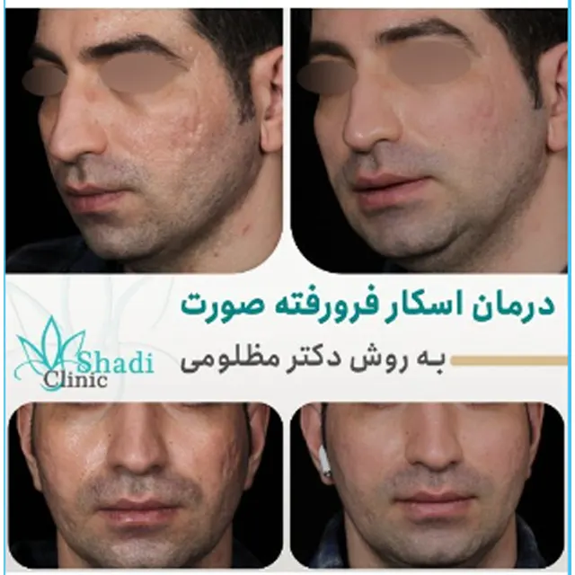 کلینیک دکتر شادی مظلومی معروف ترین متخصص پیلینگ در کرج |بهترین پزشک پیلینگ در کرج