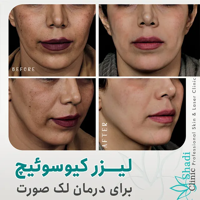 کلینیک دکتر شادی مظلومی بهترین متخصص پیلینگ در کرج |بهترین مطب پیلینگ در کرج