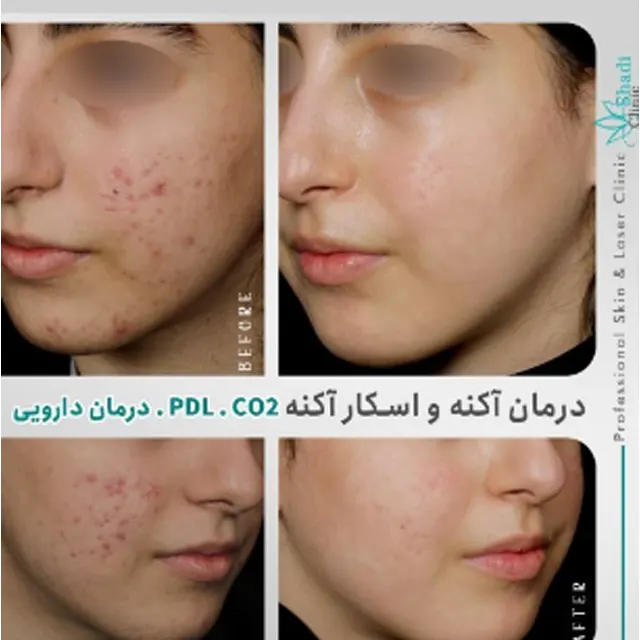 مطب دکتر شادی مظلومی بهترین مرکز پیلینگ در کرج |بهترین مطب پیلینگ در کرج