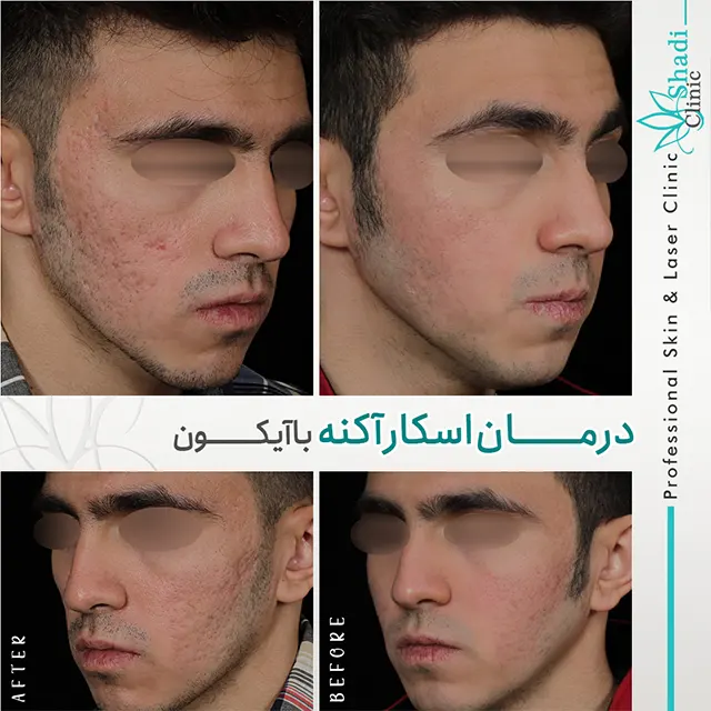 کلینیک دکتر شادی مظلومی بهترین متخصص پیلینگ در کرج |بهترین مطب پیلینگ در کرج
