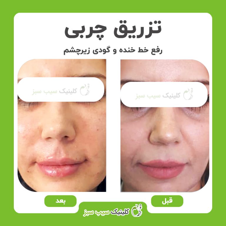 کلینیک سیب سبز کربوکسی تراپی| بهترین کلینیک کربوکسی تراپی در تهران