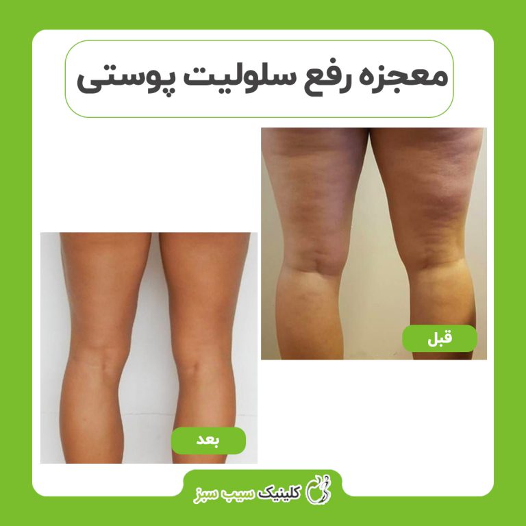 کلینیک سیب سبز بهترین کلینیک کربوکسی تراپی| بهترین مرکز کربوکسی تراپی در تهران