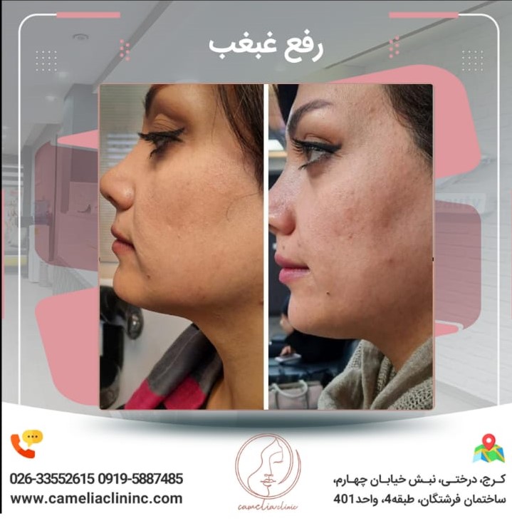 مرکز کاملیا بهترین کلینیک پیلینگ در کرج |بهترین مرکز پیلینگ در کرج