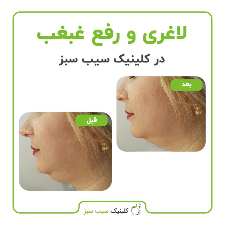 کلینیک سیب سبز کربوکسی تراپی| بهترین کلینیک کربوکسی تراپی در تهران