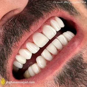 بهترین متخصص ونیر کامپوزیت در تهران | مرکز بیوتی