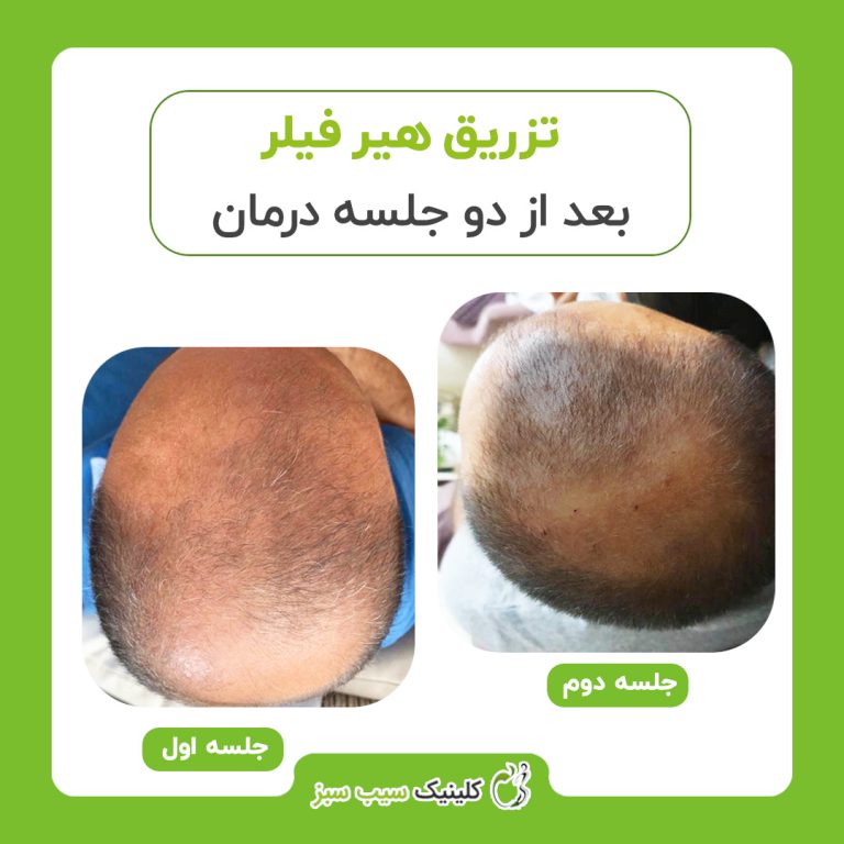 کلینیک سیب سبز بهترین کلینیک کربوکسی تراپی| بهترین مرکز کربوکسی تراپی در تهران