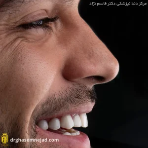 بهترین متخصص ونیر کامپوزیت در تهران | مرکز بیوتی