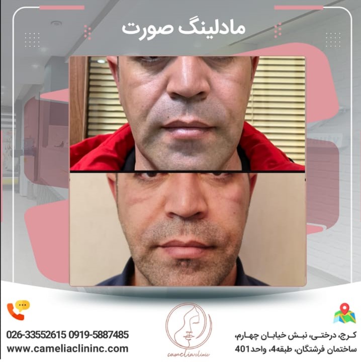 مرکز تخصصی کاملیا بهترین مطب پیلینگ در کرج |بهترین کلینیک پیلینگ در کرج