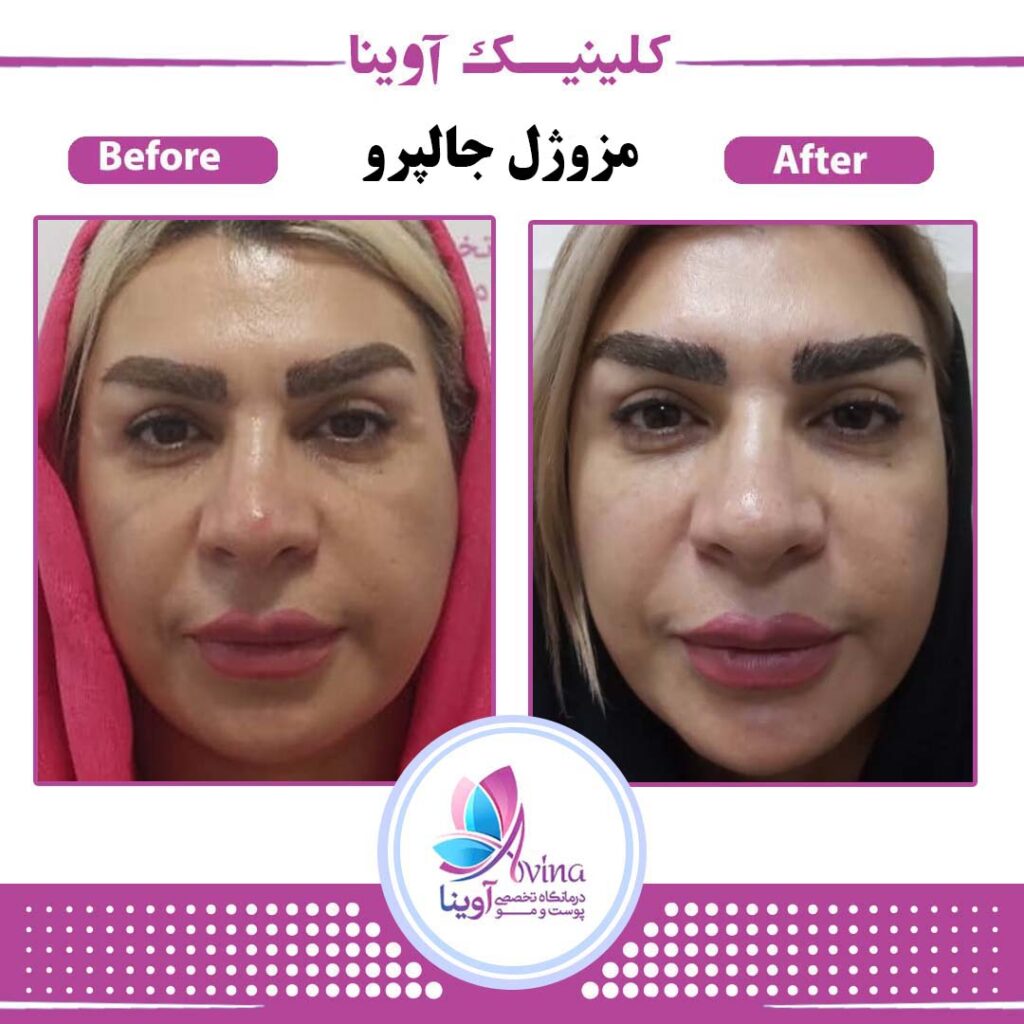 مرکز زیبایی آوینا | بهترین کلینیک کربوکسی تراپی در تهران