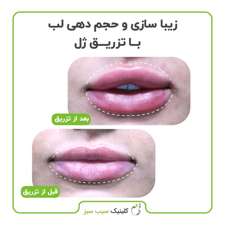 کلینیک سیب سبز کربوکسی تراپی| بهترین کلینیک کربوکسی تراپی در تهران