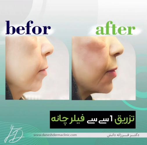 نمونه قبل و بعد فیلر چانه توسط دکتر فرزانه دانش