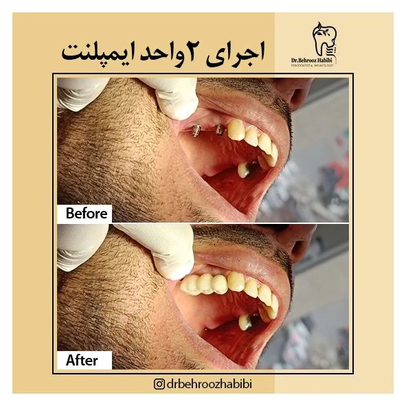 بهترین متخصص ایمپلنت فوری در تهران | مرکز بیوتی