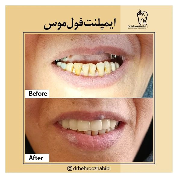 بهترین متخصص ایمپلنت فول ماکس در تهران | مرکز بیوتی