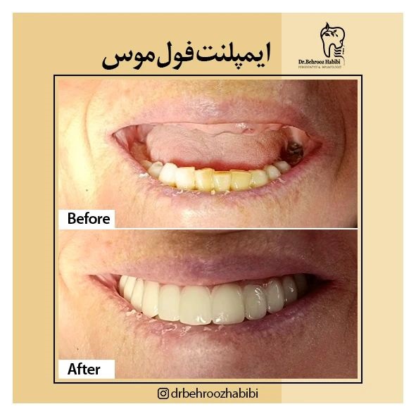 بهترین دکتر ایمپلنت فول ماکس در تهران | مرکز بیوتی