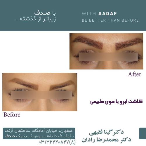 نمونه قبل و بعد کاشت ابرو انجام شده توسط کلینیک پوست و مو صدف اصفهان