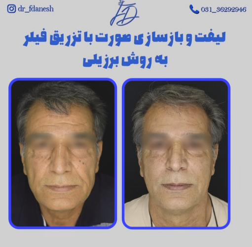 نمونه قبل و بعد لیفت صورت انجام شده توسط دکتر فرزانه دانش