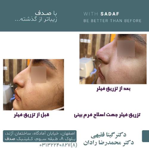 نمونه قبل و بعد فیلر صورت انجام شده توسط کلینیک پوست و مو صدف اصفهان