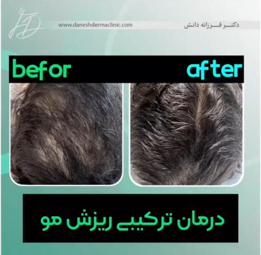 نمونه قبل و بعد درمان ریزش مو انجام شده توسط دکتر فرزانه دانش