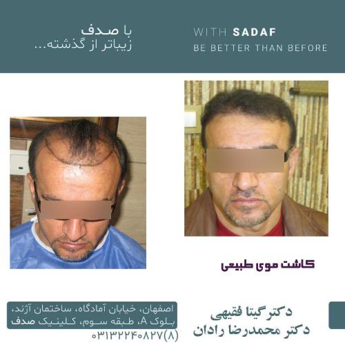 نمونه قبل و بعد کاشت مو انجام شده توسط کلینیک پوست و مو صدف اصفهان