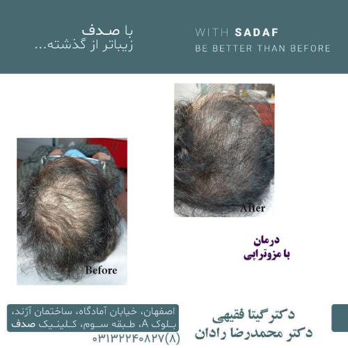 نمونه قبل و بعد مزوتراپی انجام شده توسط کلینیک پوست و مو صدف اصفهان