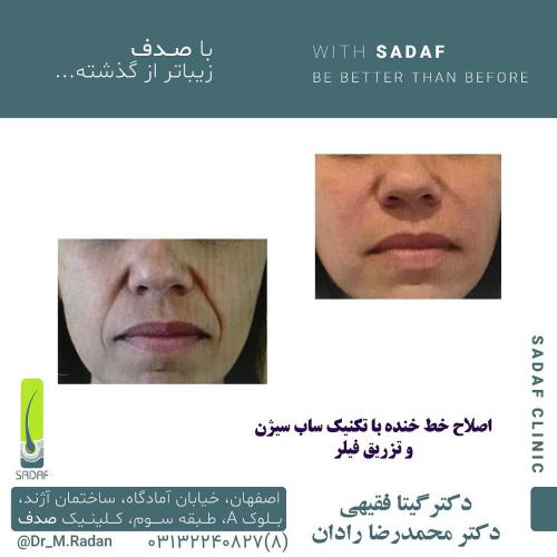 نمونه قبل و بعد اصلاح طرح لبخند انجام شده توسط کلینیک پوست و مو صدف اصفهان