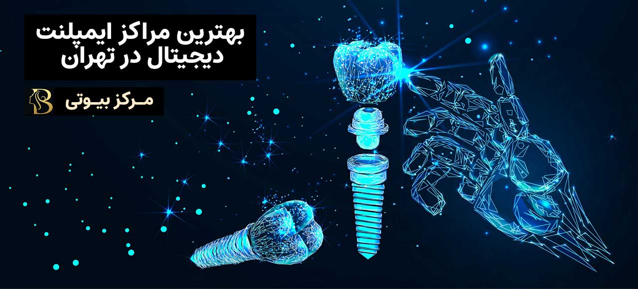 بهترین متخصص ایمپلنت دیجیتال در تهران | مرکز بیوتی