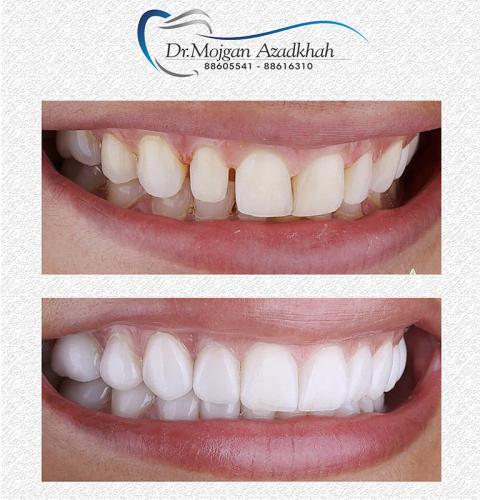 لمینت سرامیکی در کلینیک دکتر مژگان آزادخواه | مرکز بیوتی