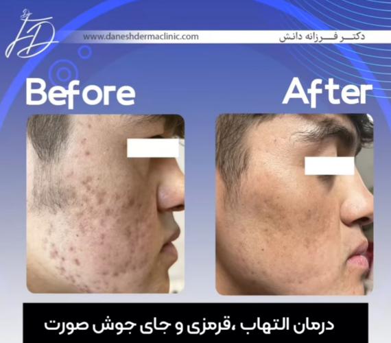 نمونه قبل و بعد درمان جای جوش و اسکار توسط دکتر فرزانه دانش