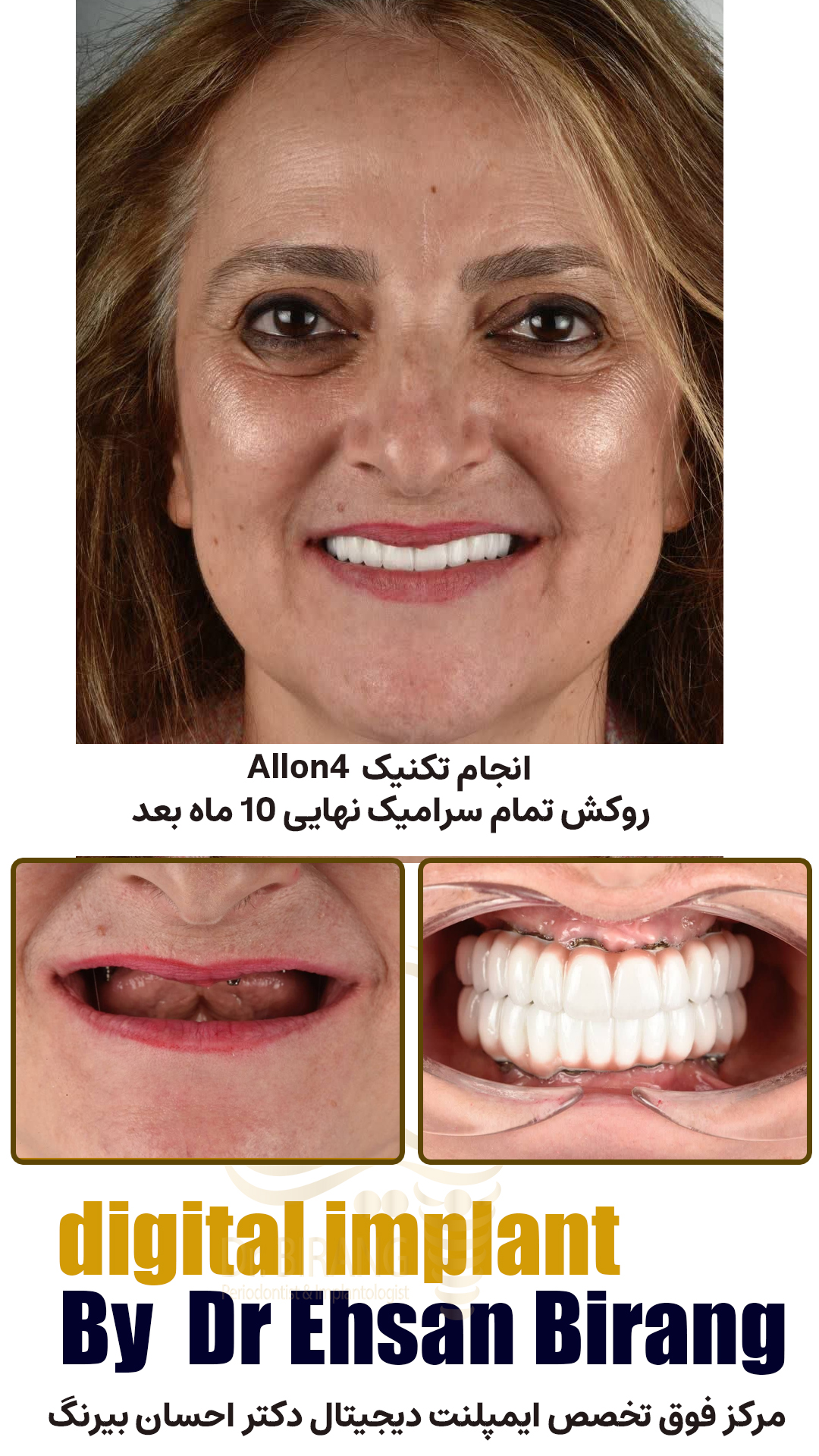 ایمپلنت دیجیتال در تهران دکتر احسان بیرنگ