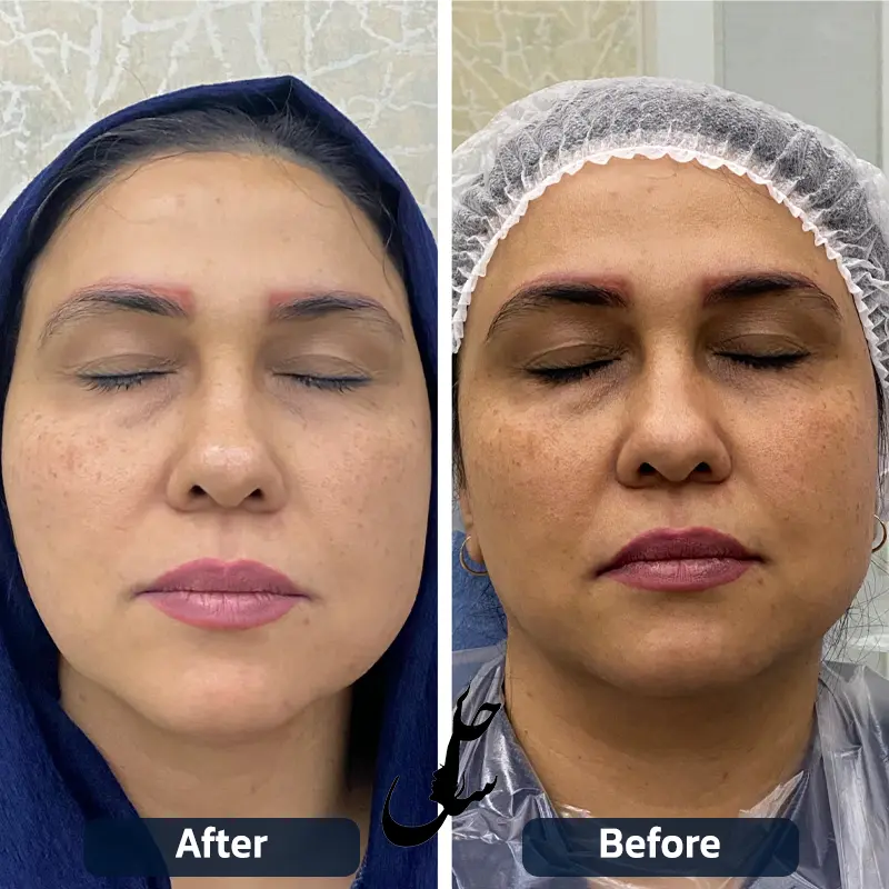 نمونه قبل و بعد درمان با هایفوتراپی