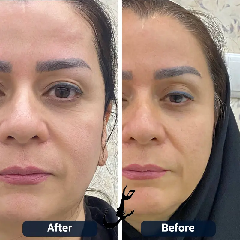 نمونه قبل و بعد درمان با هایفوتراپی