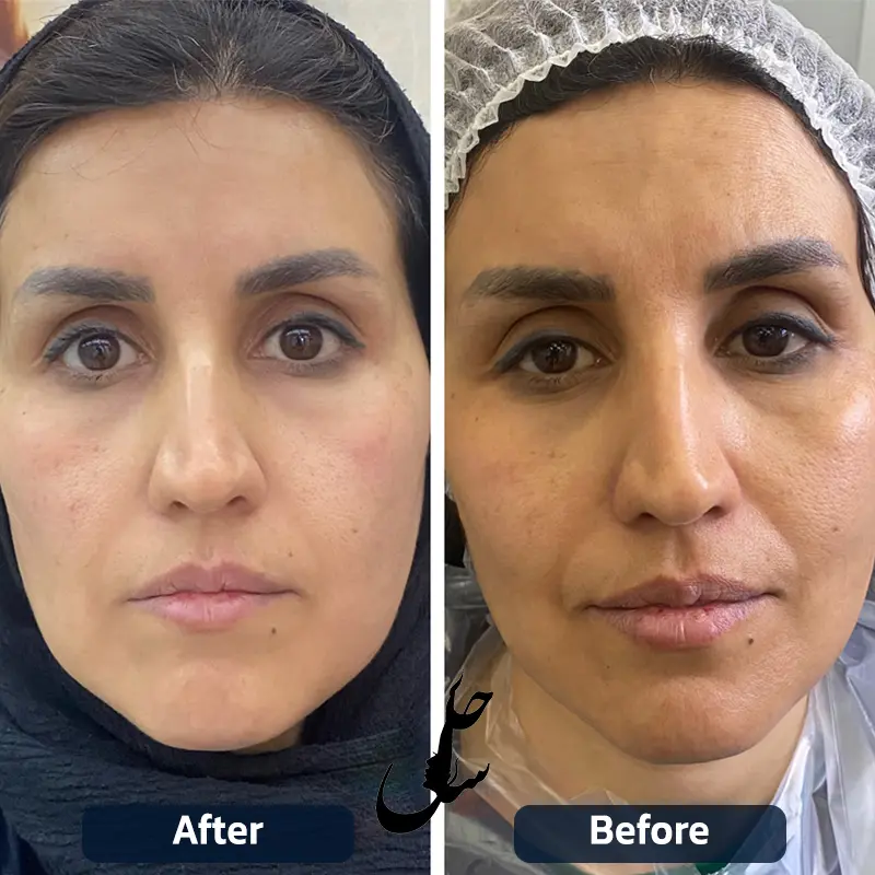 نمونه قبل و بعد درمان با هایفوتراپی