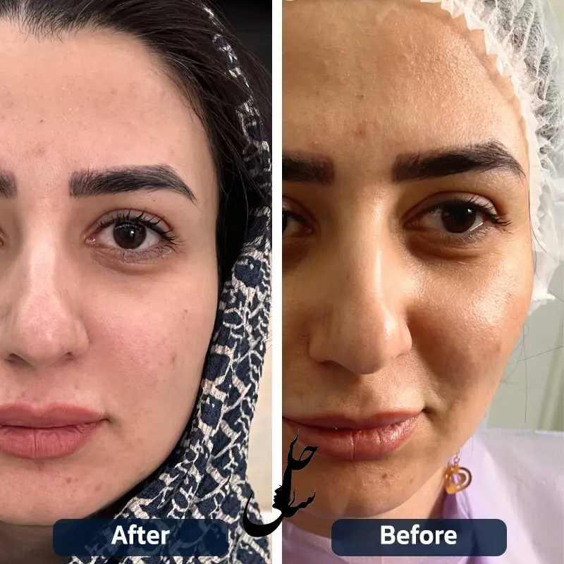 نمونه قبل و بعد جوانسازی با هایفوتراپی