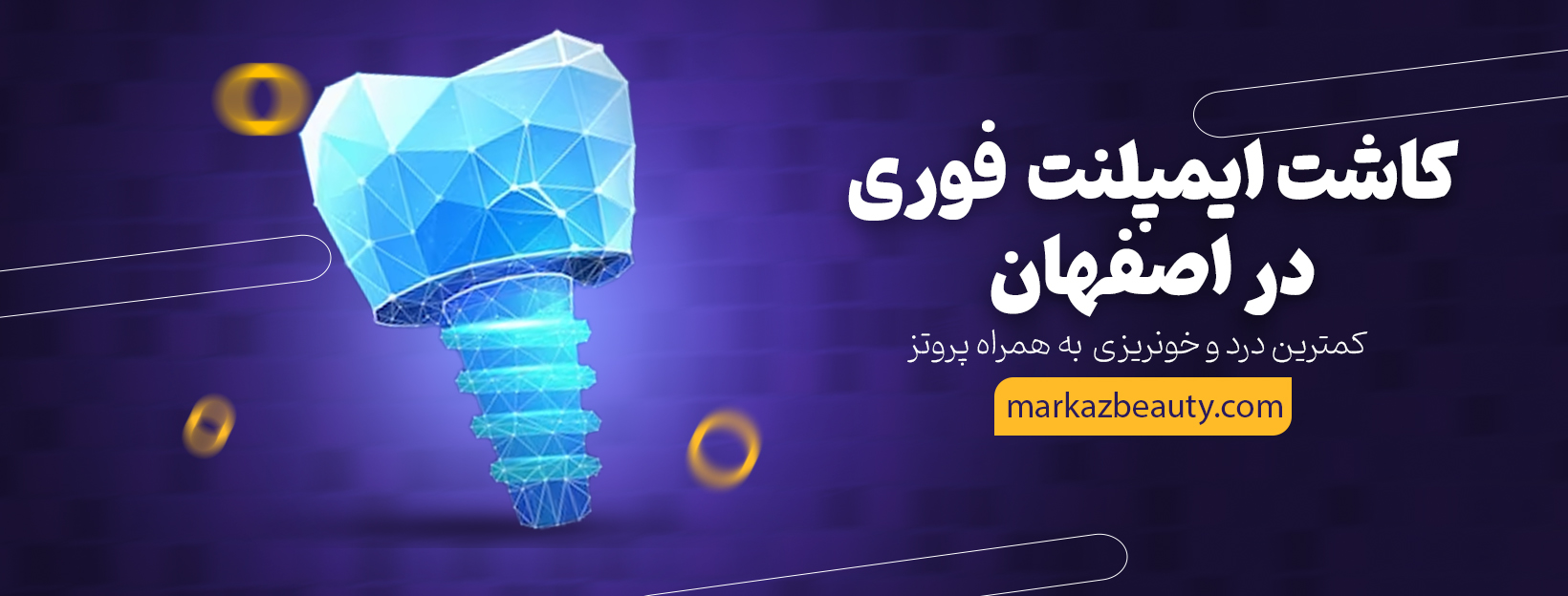 ایمپلنت فوری در اصفهان