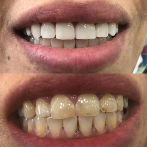 نمونه لمینت سرامیکی دندان کلینیک دندانپزشکی پارس کاشان | بهترین کلینیک دندانپزشکی کاشان