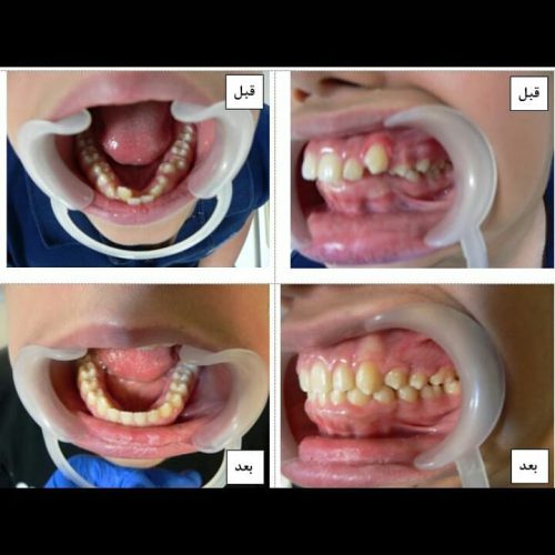 نمونه ارتودنسی دندان کلینیک دندانپزشکی پارس کاشان | بهترین کلینیک دندانپزشکی کاشان