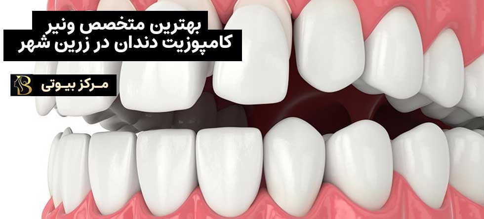 بهترثین مراکز کامپوزیت دندان در زرین شهر | مرکز بیوتی