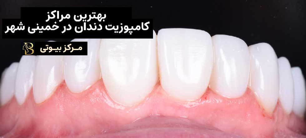 بهترین دکتر ونیر کامپوزیت در خمینی شهر | مرکز بیوتی