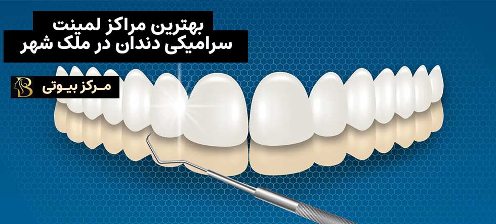 بهترین مرکز لمینت سرامیکی دندان در ملک شهر اصفهان | مرکز بیوتی