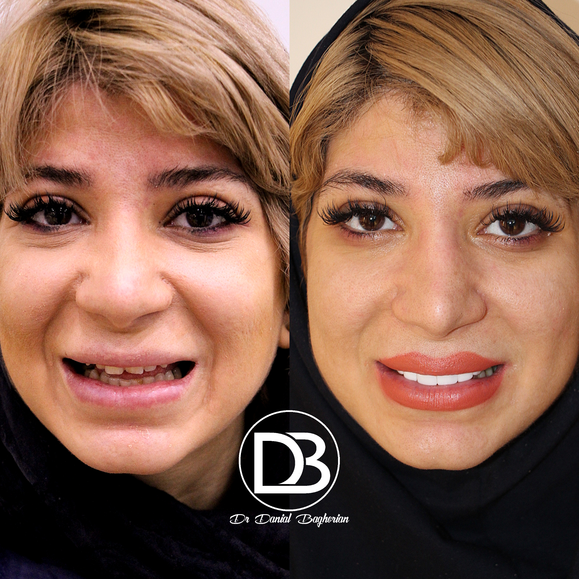 ونبر کامپوزیت در زرین شهر